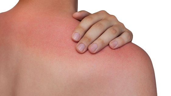 Treating Heat Rash: Essential Tips